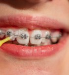 שיניים צפופות - תמונת המחשה